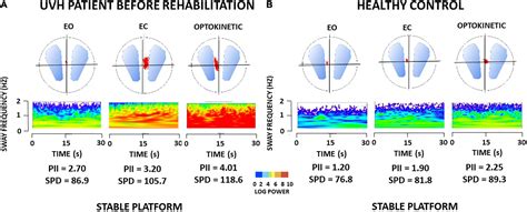 Frontiers | Posture Deficits and Recovery After Unilateral Vestibular ...