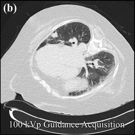 Lung Nodule Biopsy With Low Dose Ct Guidance Protocol Single Images