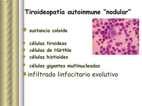 Pdf Citolog A Tiroidea Lesion Folicular Endosuem Org Uy Wp Content