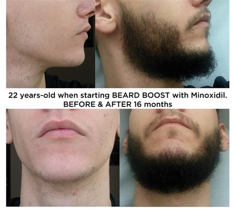 Minoxidil Before And After