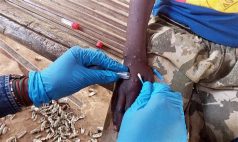 Sweden Reports First Case Outside Africa Of New Mpox Strain Bno News