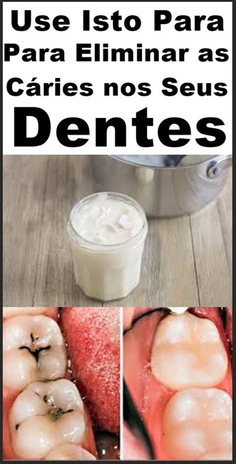 Receita Caseira Para Eliminar A Cárie Nos Dentes Dicas De Saúde