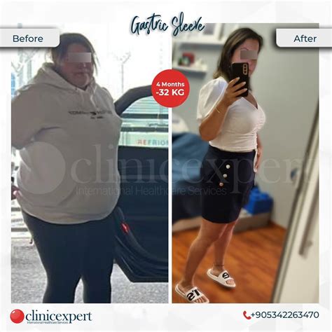 Gastric Sleeve Before And After Photos The Best Pictures Of Off