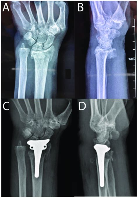 A Preoperative X Ray Ap B Preoperative Lateral View C