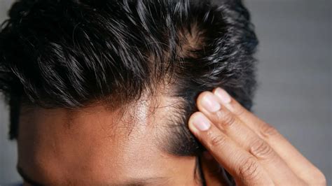 15 Ways How To Regain Hair Loss From Stress