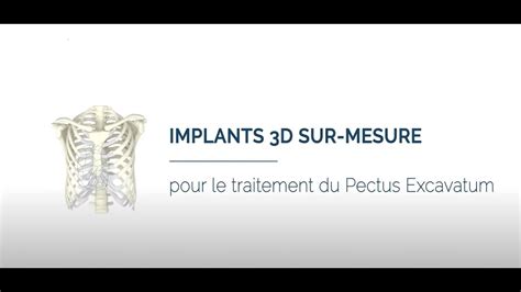 Correction De Pectus Excavatum Par Implant Sur Mesure Dr Correia