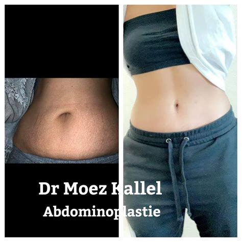 Abdominoplastie Tunisie Chirurgie Du Ventre Avant Et Apr S