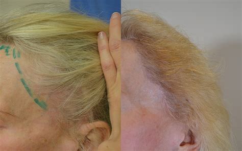 Hair Transplant Case Study - Female Hairline Lowering and Facelift Scar ...