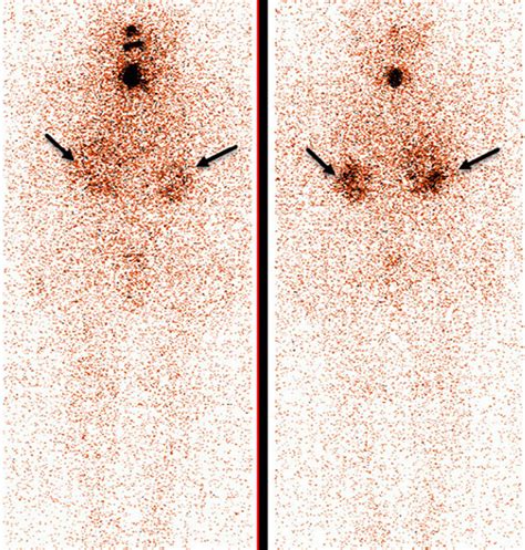 Post Treatment Whole Body Scan Shows Thyroid Remnant Tissue And