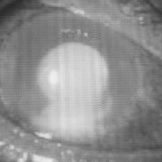 Anterior Segment Photograph Of The Left Eye Showing Fibrinous Reaction