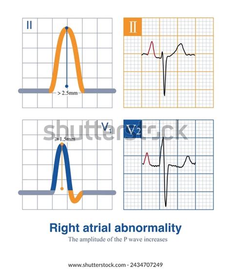 Standard Diagnosing Right Atrial Abnormality Ecg Stock Illustration