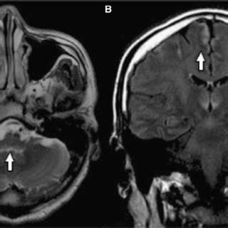 Typical MRI findings in Wernicke encephalopathy-Axial T2-weighted ...