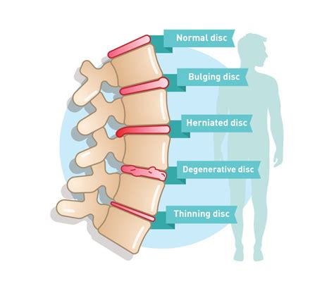 Degenerative Disc Disease - Symptoms & Causes