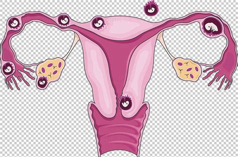 Ectopic Pregnancies Vector Illustration