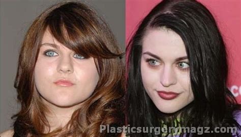 Frances Bean Cobain Plastic Surgery Pictures Plastic Surgery Diary