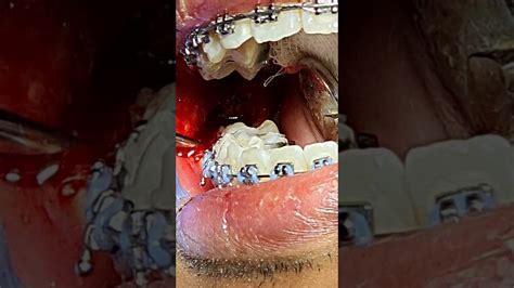 32 Complete Bony Impacted Wisdom Tooth Youtube