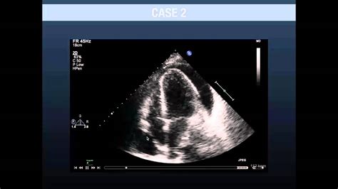 Pericardial Tamponade Ultrasound