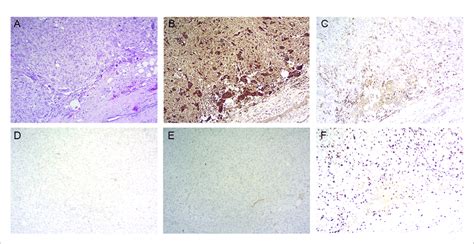 Histopathology Of Primary Tumor A Hematoxylin And Eosin Staining Download Scientific