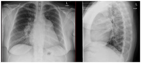 Chest X Ray Demonstrating Enlarged Cardiac Silhouette With Mediastinal