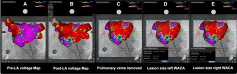 Frontiers Wide Antral Circumferential Vs Ostial Pulmonary Vein