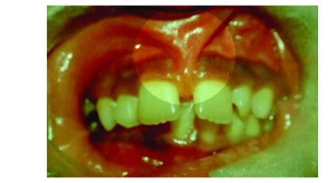 33 Fibrous Upper Labial Frenum Observe Presence Of Median Diastema