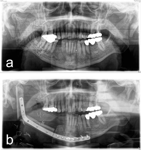 Figure 2 From Osteoradionecrosis Of The Jaw—comparison Between Bone And