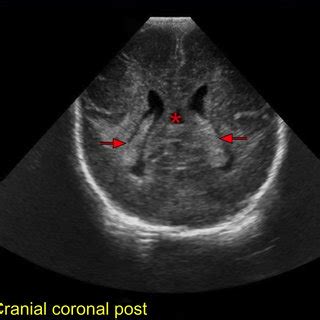 Normal Neonatal Head Ultrasound Anatomy