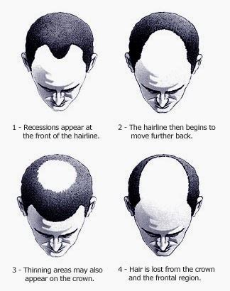 Male Pattern Baldness Cure: Male Pattern Baldness- Causes and Symptoms