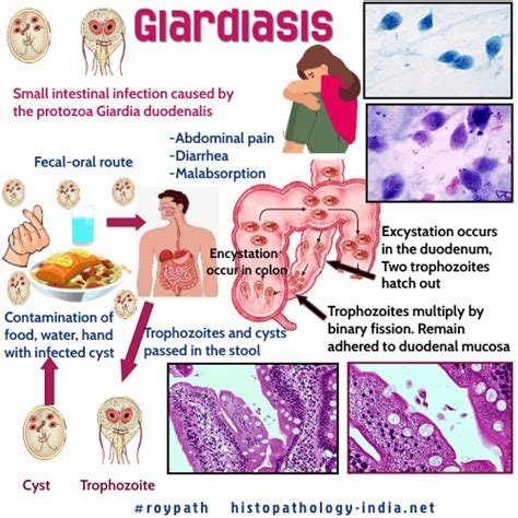 Pathology Of Giardiasis Dr Sampurna Roy Md