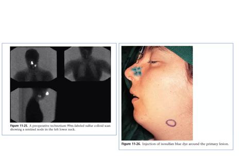 Sentinel Lymph Node Biopsy Pptx