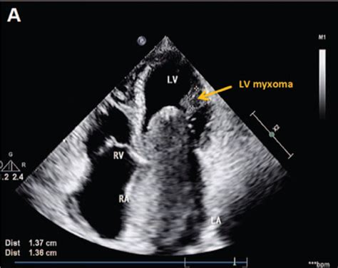 Left Atrial Myxoma With Left Ventricular Myxoma Diagnosed By Ultrasound Examination A Case