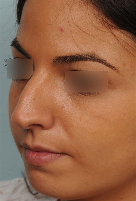 Photos De Rhinoplastie Avec Pointe De Nez Bifide Avant Et Apr S