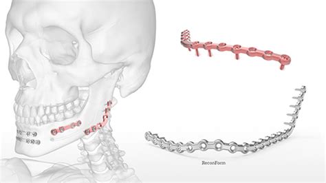 Osteomed Mfx Mandibular Fixation System Acumed