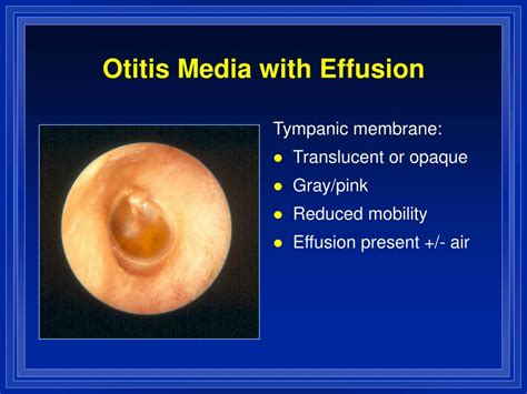 Ppt Otitis Media And Eustachian Tube Dysfunction Powerpoint