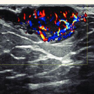 Colour Doppler Ultrasound Image Of The Left Breast Of A 35 Year Old