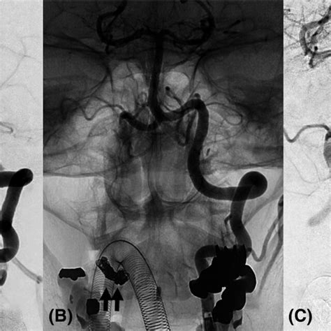 A Preoperative Left Vertebral Artery Angiogram Of A 58yearold Woman