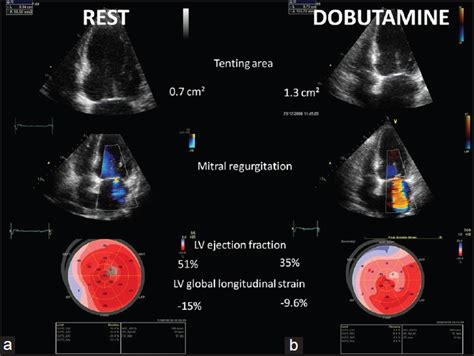 Dobutamine Stress Echocardiogram Shivam Diagnostics Centre