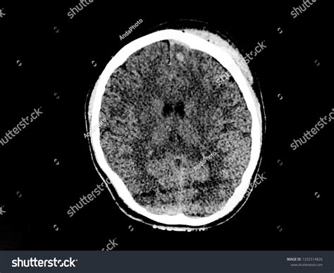 ct scan brain showed subdural hematoma stock photo edit