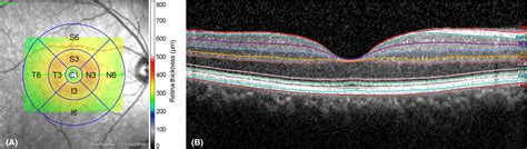 Optical Coherence Tomography Analysis Of Inner And Outer Retinal Layers