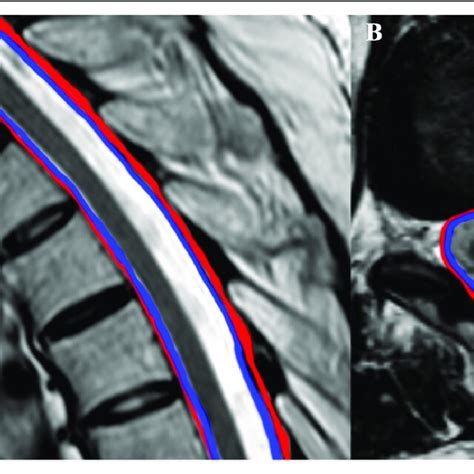 Sagittal T2 depicts the epidural space in red and the subdural space in ...