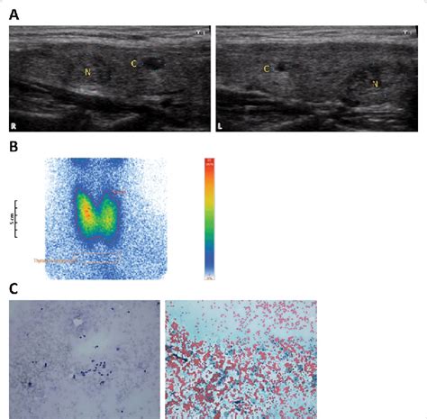 Clinical investigation of the thyroid gland and cold thyroid nodule ...