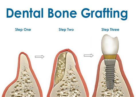 Bone Grafting|Vancouver General Dentistry | Dr. David Huh | Four ...