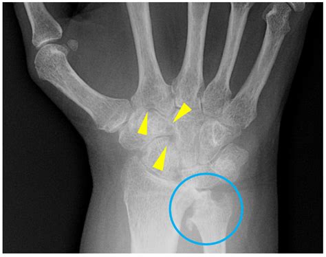 Punched Out Erosions Meaning at Velma Wright blog