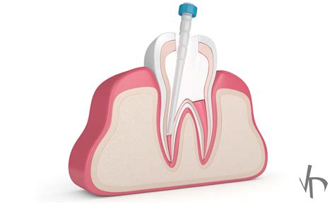 Tooth Core Build Up: Procedure Features and Advantages - VDM Dental ...