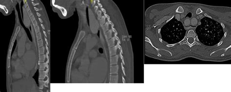 3 questions with answers in TRACHEOESOPHAGEAL FISTULA | Science topic