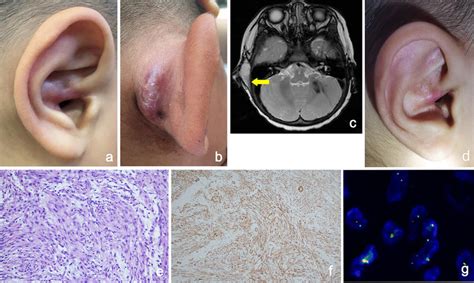 Findings In Patient 2 A B Pre Operative Clinical Photographs Showing