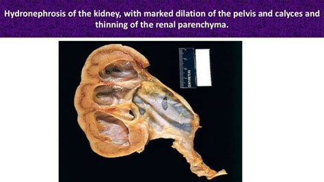 Hydronephrosis