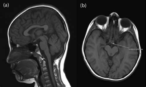 Pituitary Gland Mri Anatomy