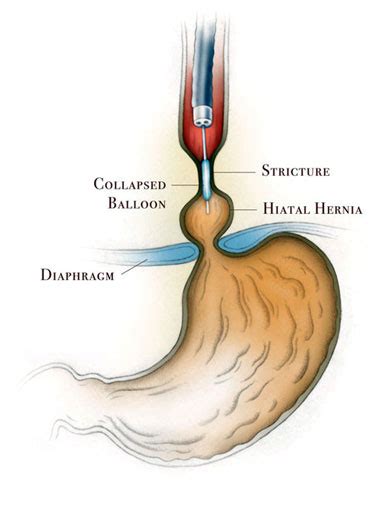 Peptic Esophageal Stricture Treatment