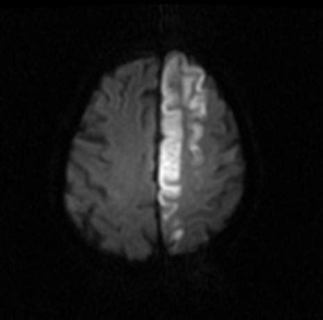 Ischemic stroke MRI - wikidoc